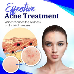 Acne Treatment Essence Serum